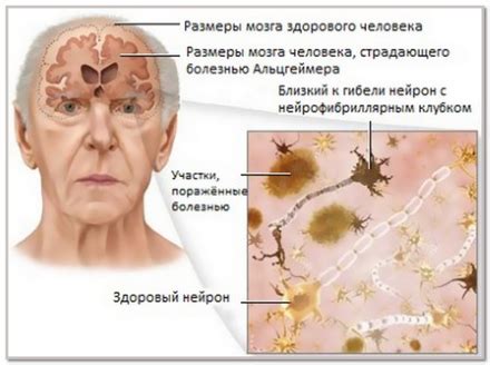 Альцгеймера болезнь