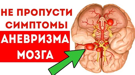 Аневризм головного мозга