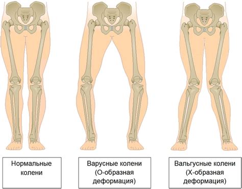 Варусная деформация коленных суставов