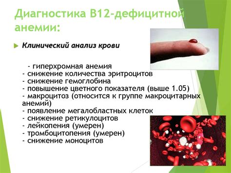 В12 дефицитная анемия