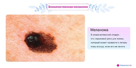 Злокачественная меланома