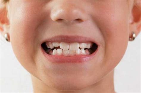 Как понять молочный зуб или коренной