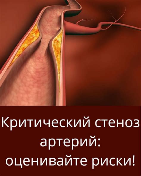 Стеноз артерий
