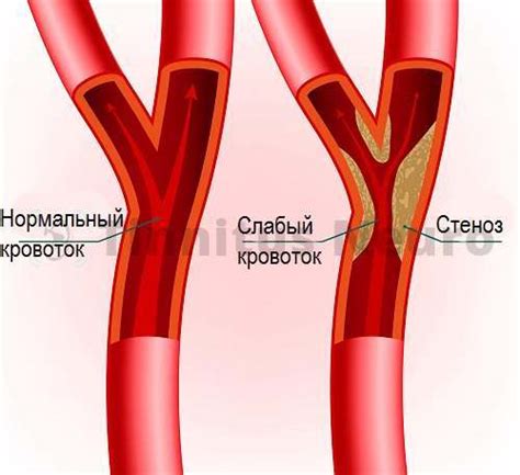 Стеноз артерий
